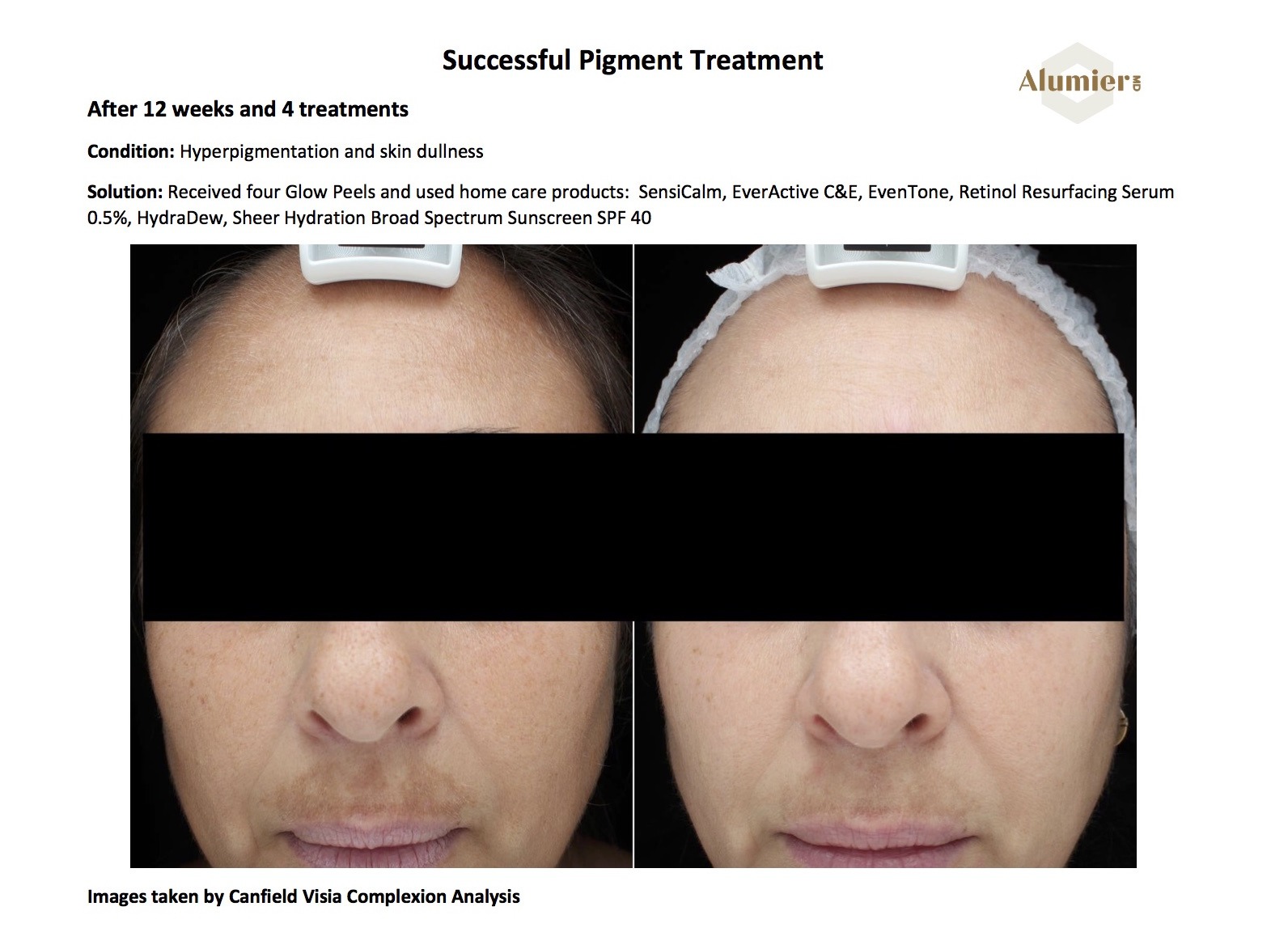AlumierMD-pigment-treatment-results